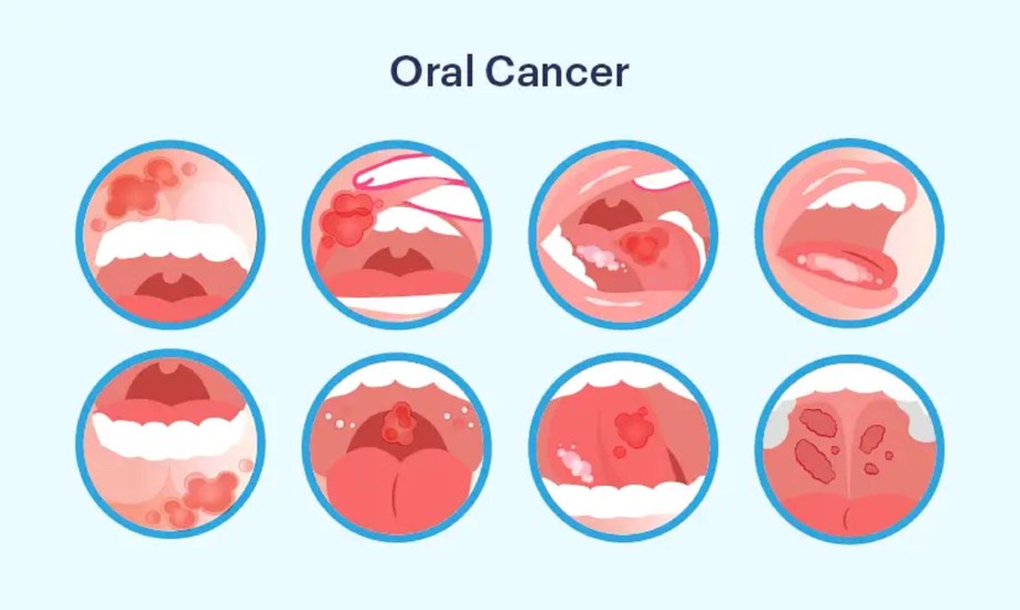 أسباب وأعراض أورام الفك