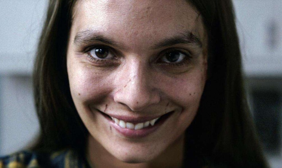 متلازمة الشيطان.. لغز مرض نادر يُظهر البشر بملامح مشوهة