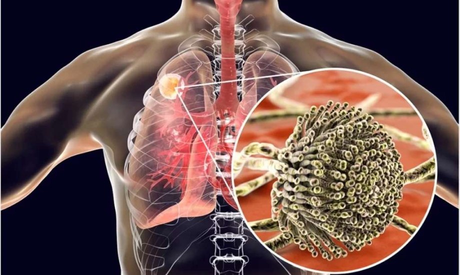 فطر الرشاشيات.. وباء العصر الجديد في ظل الاحترار العالمي