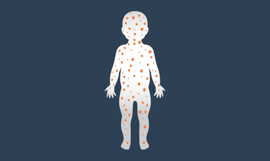 انخفاض معدلات التطعيم يزيد من خطر الإصابة بالحصبة