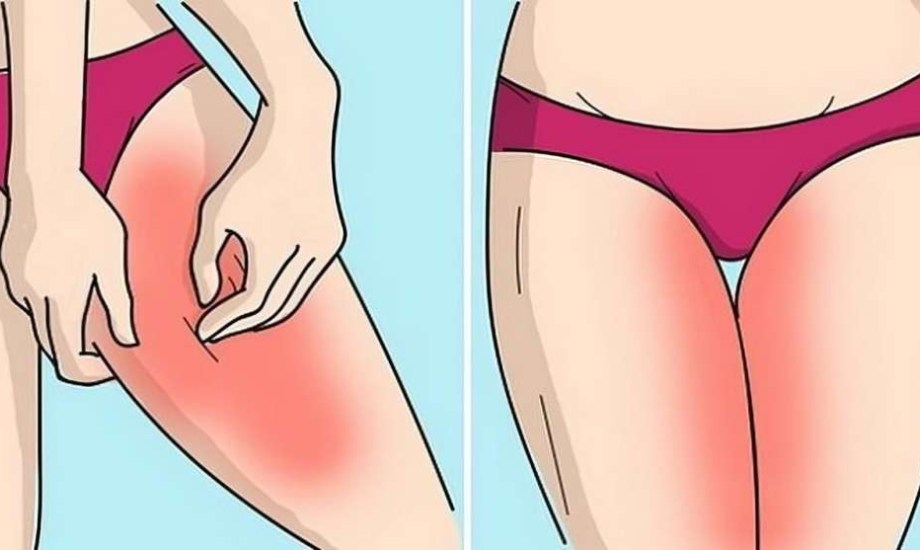 أسباب الطفح الجلدي بين الفخذين