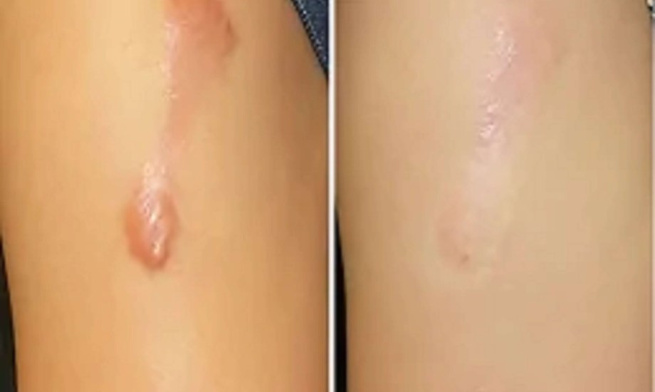  العلاجات المناسبة لندبة الجدرة