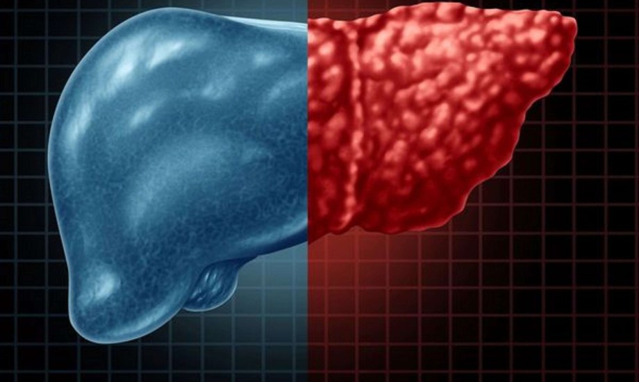 عقار أوزيمبيك لعلاج الكبد الدهني