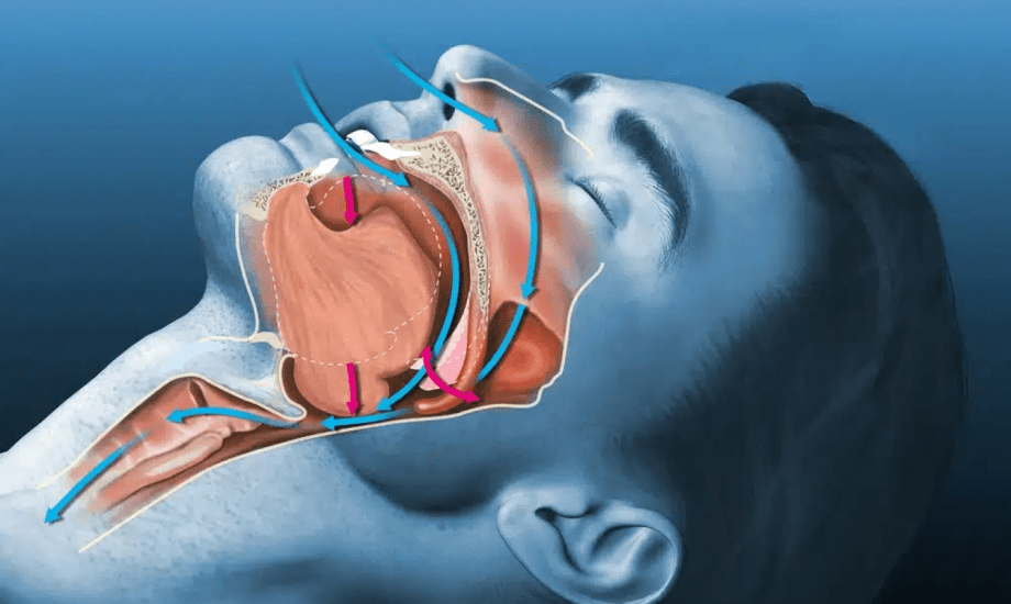 مخاطر انقطاع النفس أثناء النوم