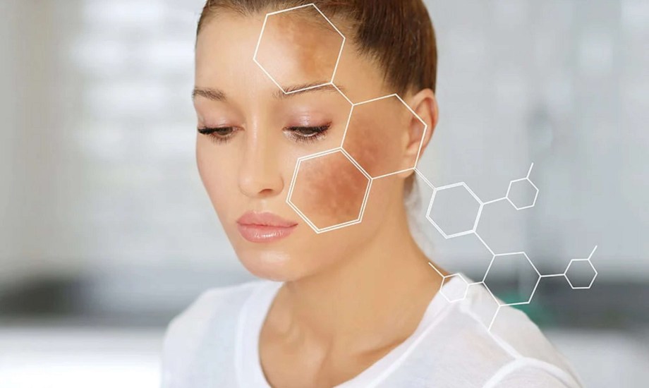 التخلص من البقع الداكنة بعد علاج الأكزيما