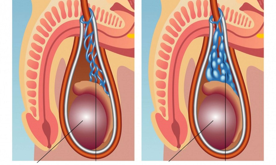 هل تؤثر دوالي الخصية على الخصوبة؟