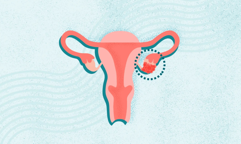 دواء جديد لعلاج سرطان المبيض