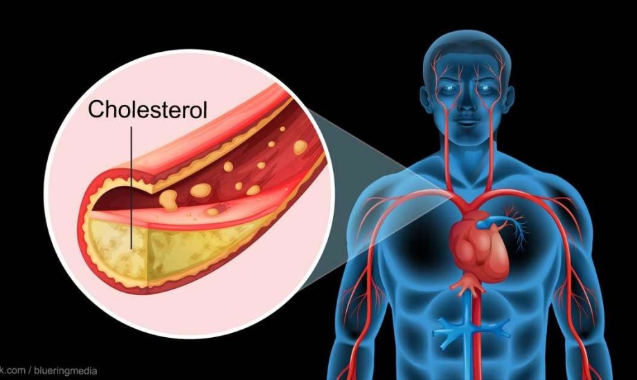 دواء جديد لعلاج الكوليسترول