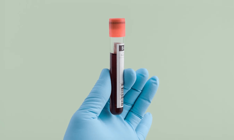 اختبار دم جديد يكتشف ألزهايمر مبكراً