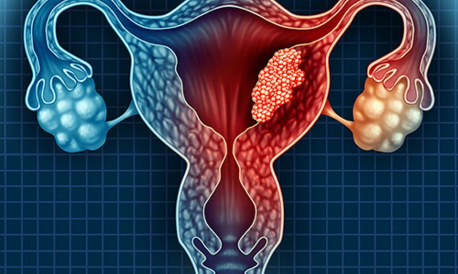 أسباب وأنواع بطانة الرحم المهاجرة