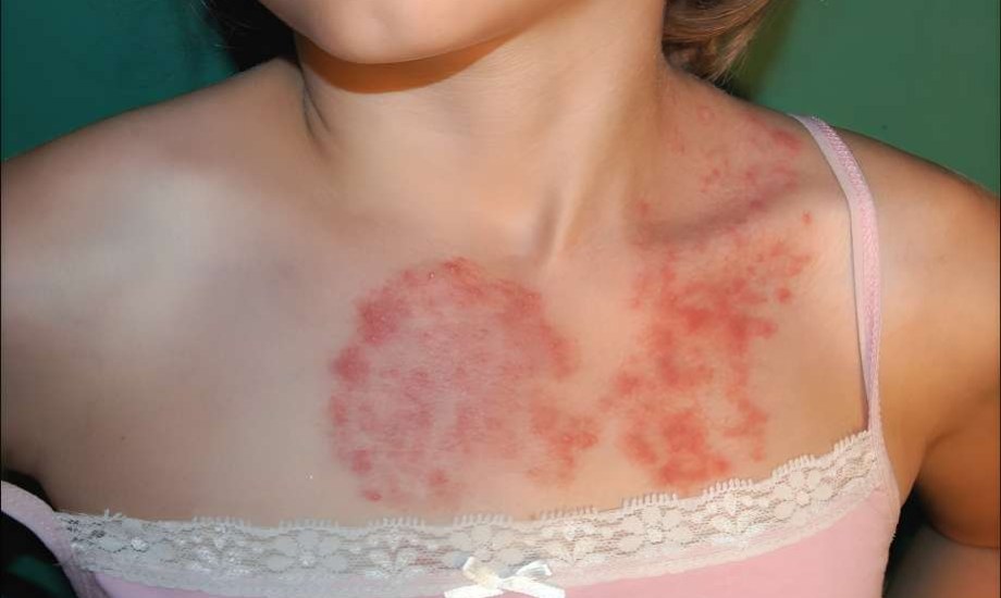 أسباب التينيا عند الأطفال