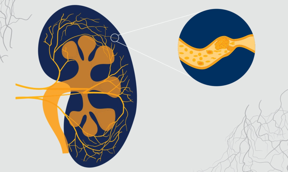 متلازمة انحلال الدم اليوريمية.. أعراضها وأسبابها وأنواعها