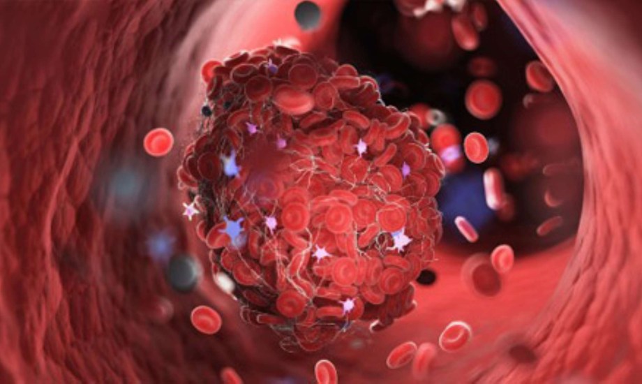 أعراض متلازمة الأجسام المضادة للفوسفوليبيد وأسبابها