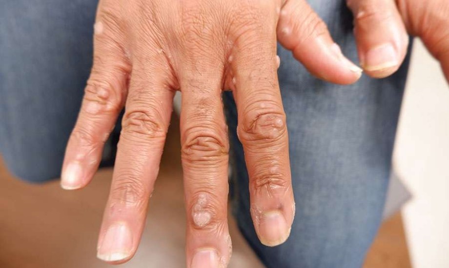 الورم الشوكي الجلدي عند الرجال