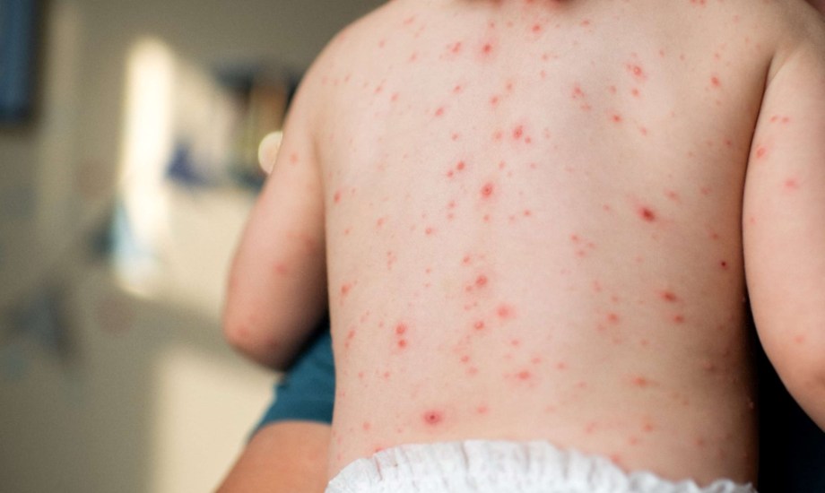 الحمى القرمزية.. أعراضها وأسبابها ومضاعفاتها