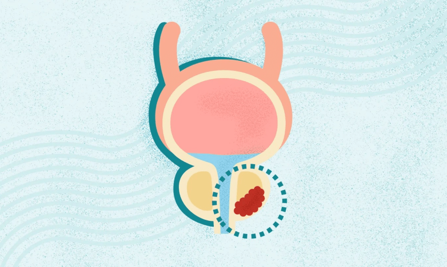 تحدد نوع ورم البروستاتا يساعد في التشخيص الدقيق  