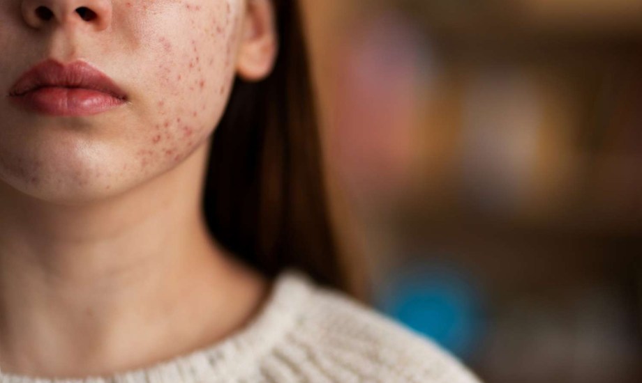 احذر  هذه البثور.. قد تكون مؤشرا خطيرا على أورام الجلد