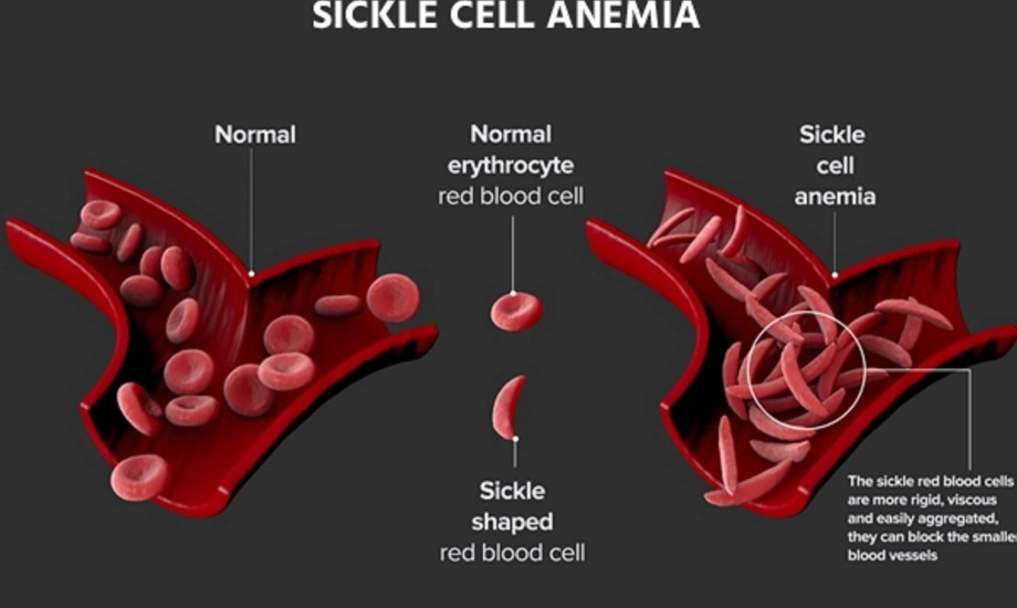 فقر الدم المنجلي عند الأطفال
