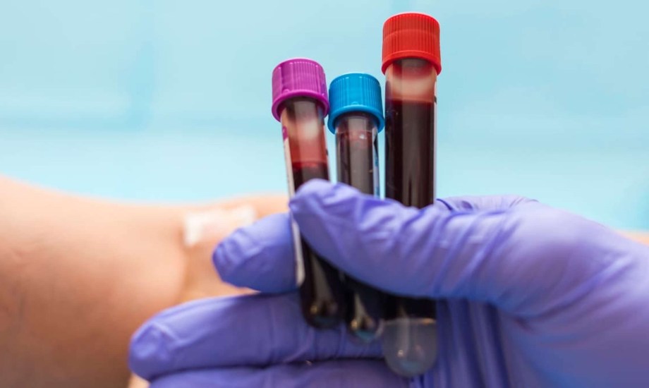 اختبار دم جديد للرضع لتحديد الأمراض النادرة مبكرا