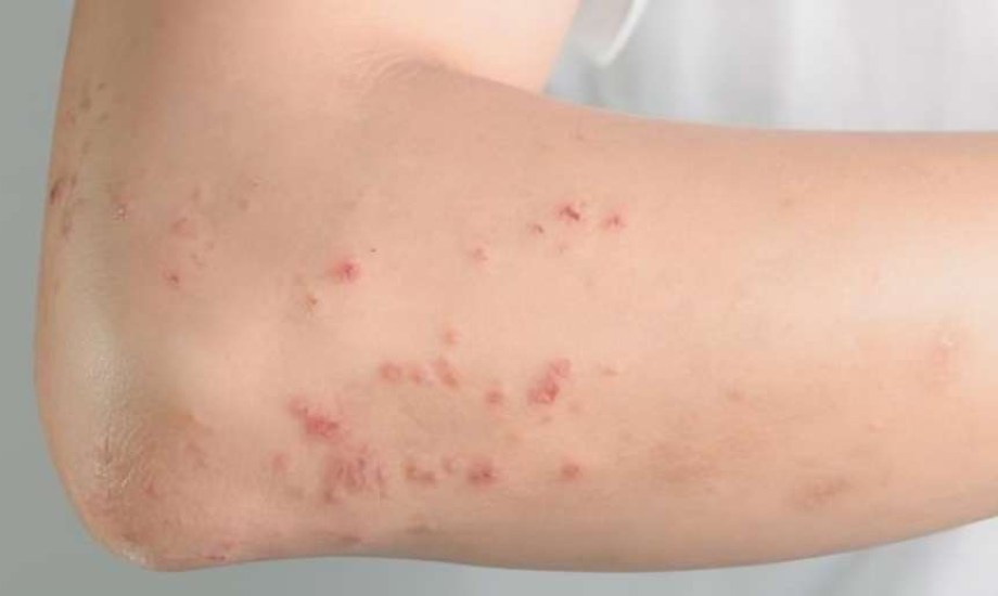  علامات التأق التحسسي 