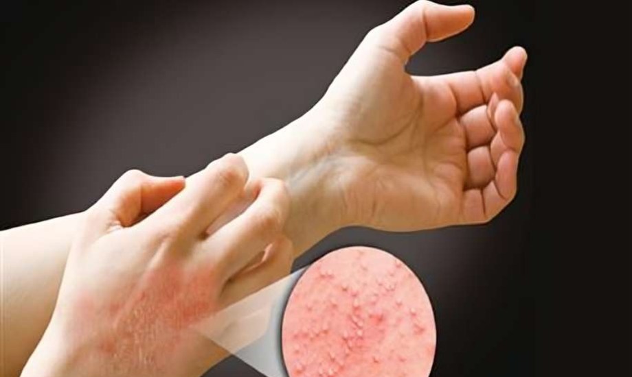 علامات الإصابة بالصدمة التحسسية