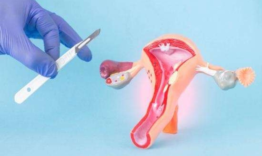 استئصال المبيضين ينقذ حياة 48% من حاملات جينات أورام الثدي