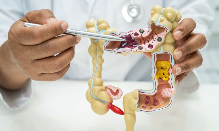 5 أطعمة ومشروبات ممنوعة لمرضى القولون التقرحي