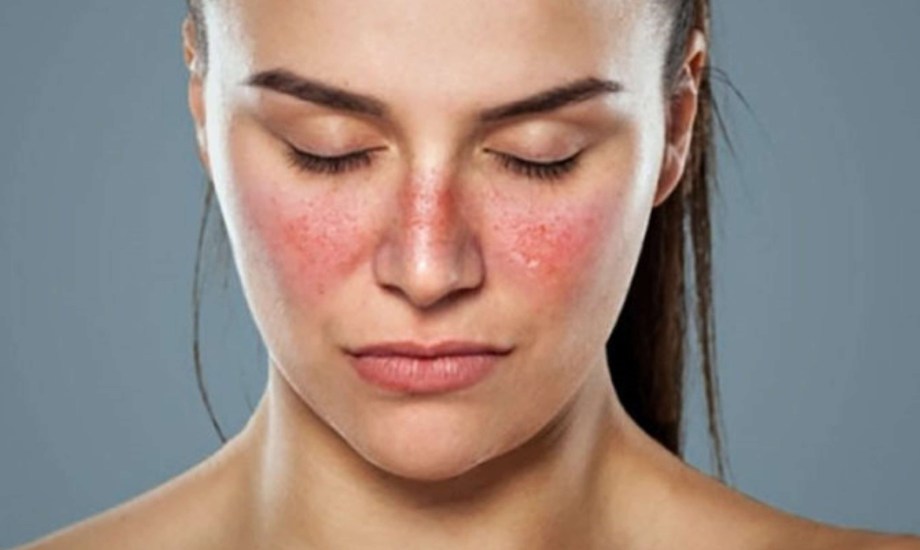 مرض جلد الفراشة.. الأسباب والأعراض والأنواع وطرق العلاج
