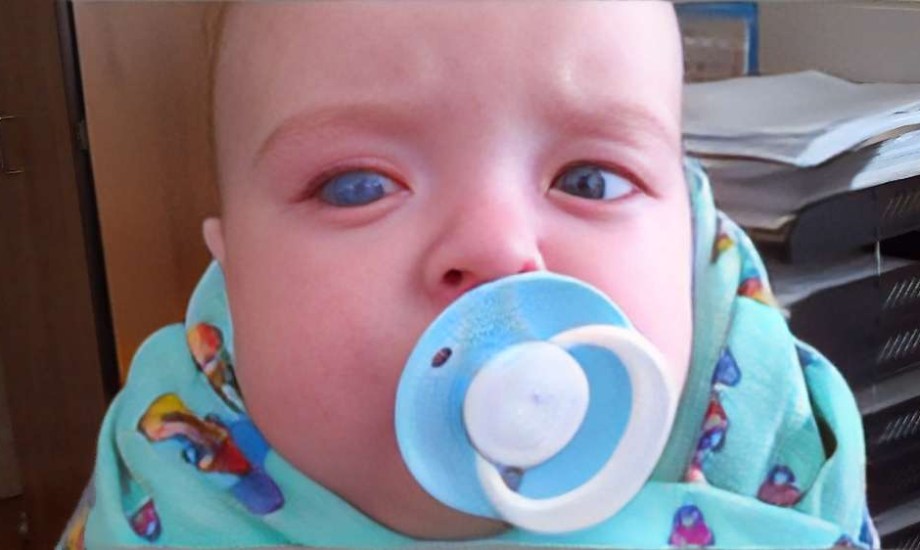 تقنية جديدة تكتشف الجلوكوما عند الرضع