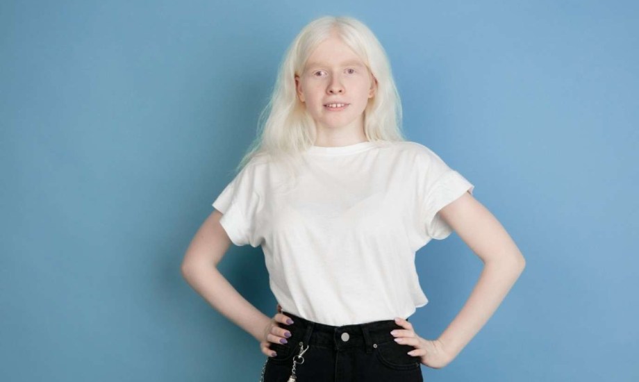 لمرضى المهق.. 6 نصائح طبية ضرورية للوقاية من أورام الجلد