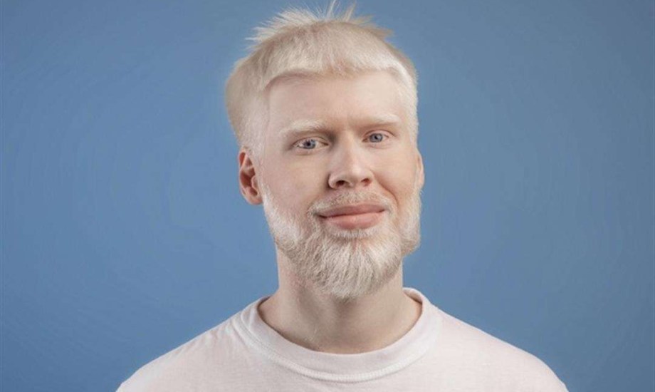 الأسباب العلمية الحقيقية للإصابة بالمهق