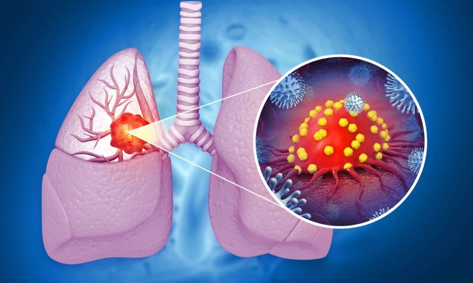 الموافقة على دواء Ibtrozi لورم الرئة المتقدم