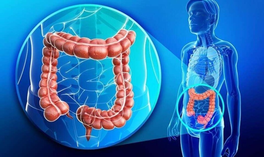 وصفة ثورية لمكافحة عودة أورام القولون