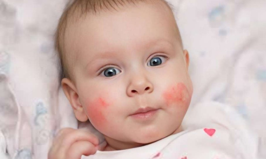 أسباب حروق الشمس عند الرضع