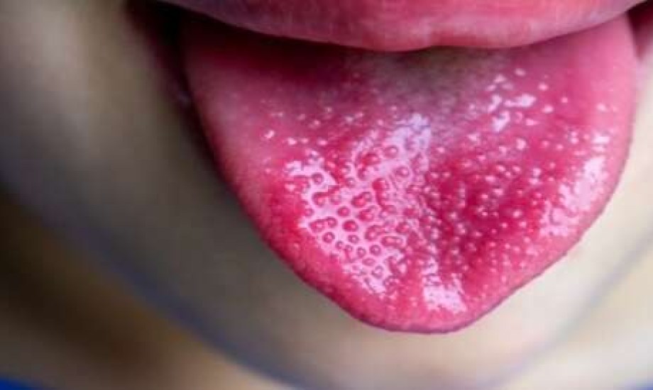 6 أسباب وراء لسان الفراولة عند الأطفال
