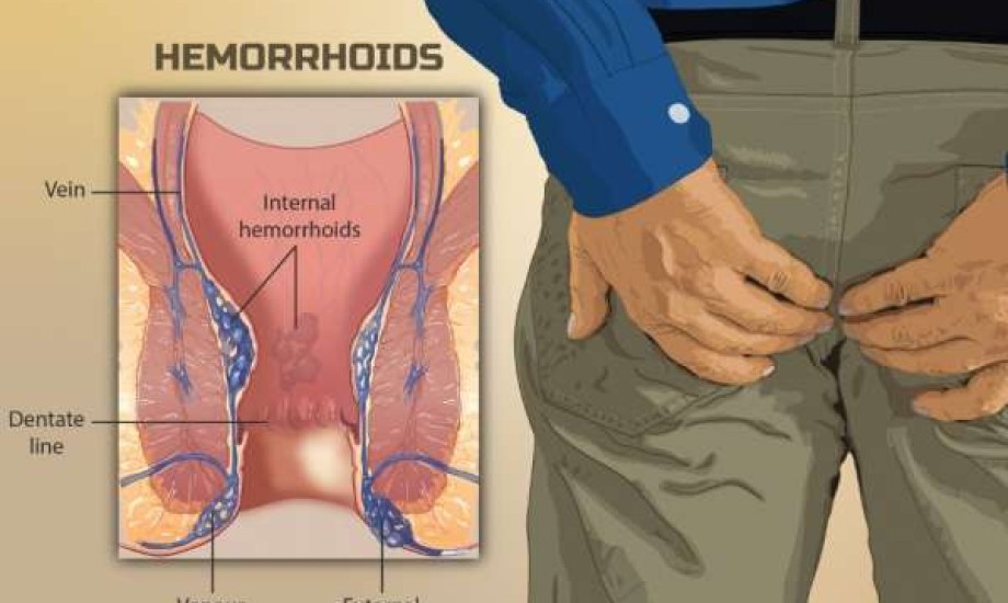هل البواسير تسبب آلام الظهر والمعدة؟