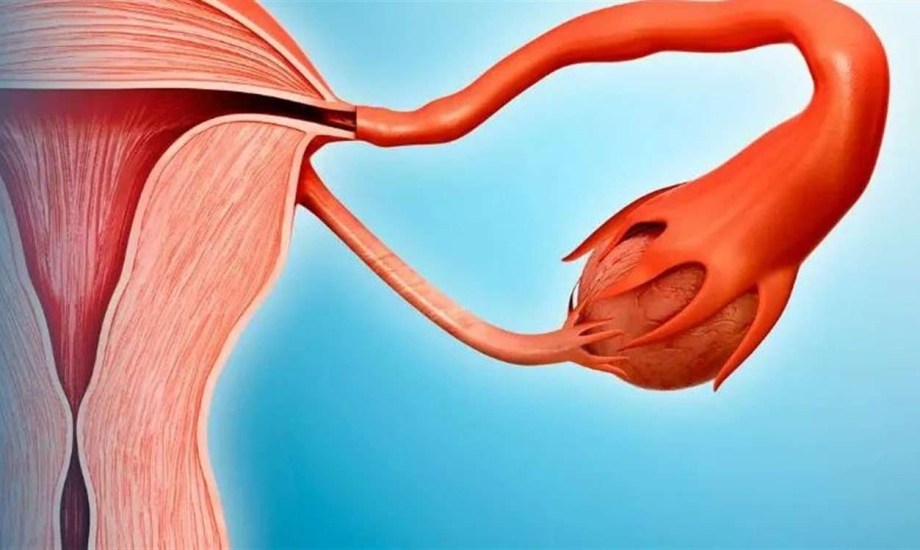 هل إزالة قناة فالوب تقي من الإصابة بأورام المبيض؟