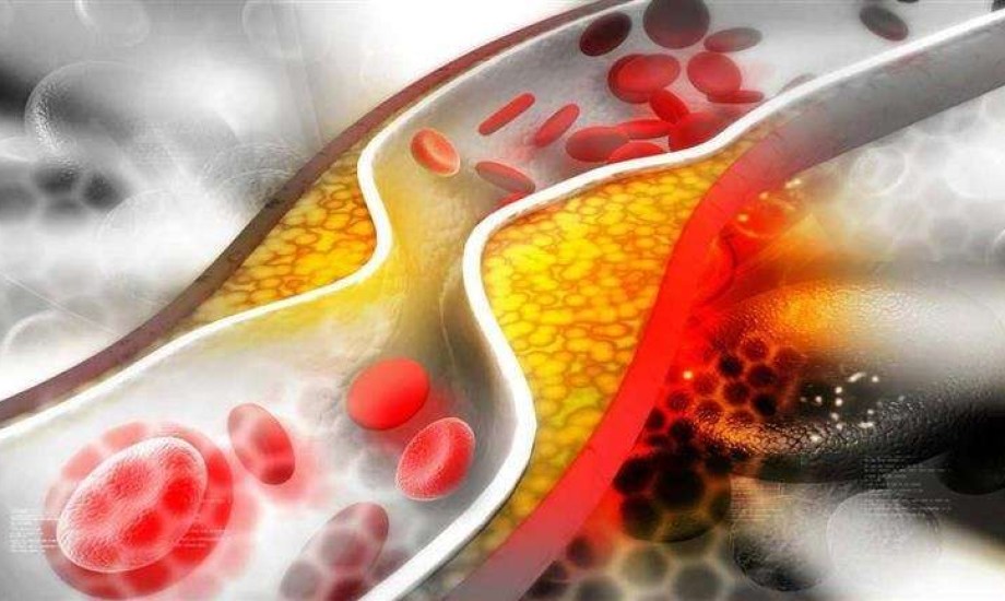 4 عادات تظنها صحية لكنها تدمر مستوى الكوليسترول لديك