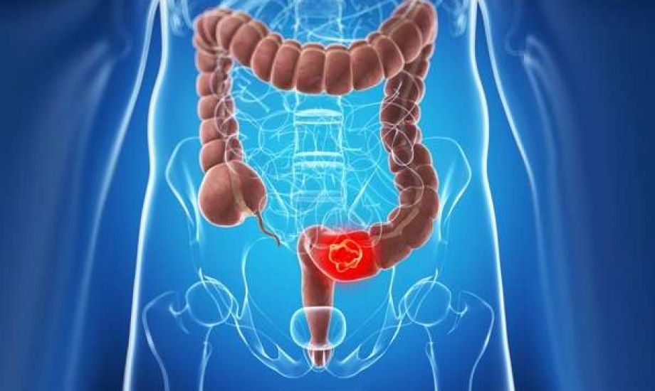 ما علاقة الخبز الأبيض بزيادة أورام القولون والمستقيم؟