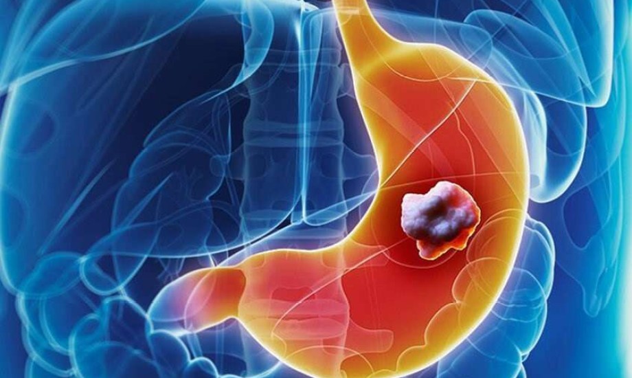 دواء &quot;بيماريتوزوماب&quot;.. هل هو العلاج المنتظر لأورام المعدة؟