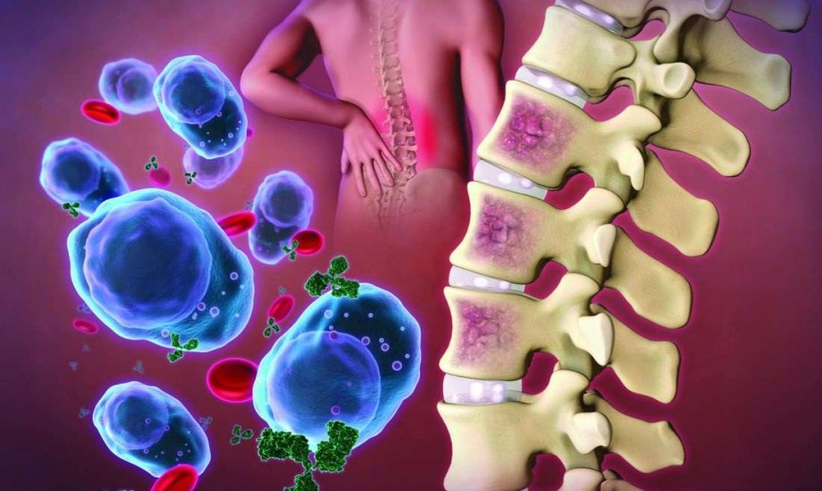 دواء "Lynozyfic".. أول علاج ثنائي النوعية للورم النخاعي المتعدد المقاوم للعلاج