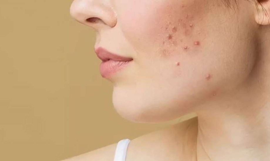 كيف تعالج حب الشباب الهرموني من دون أدوية؟