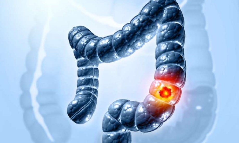 التمارين الرياضية تقلل خطر عودة ورم القولون وتخفض الوفيات