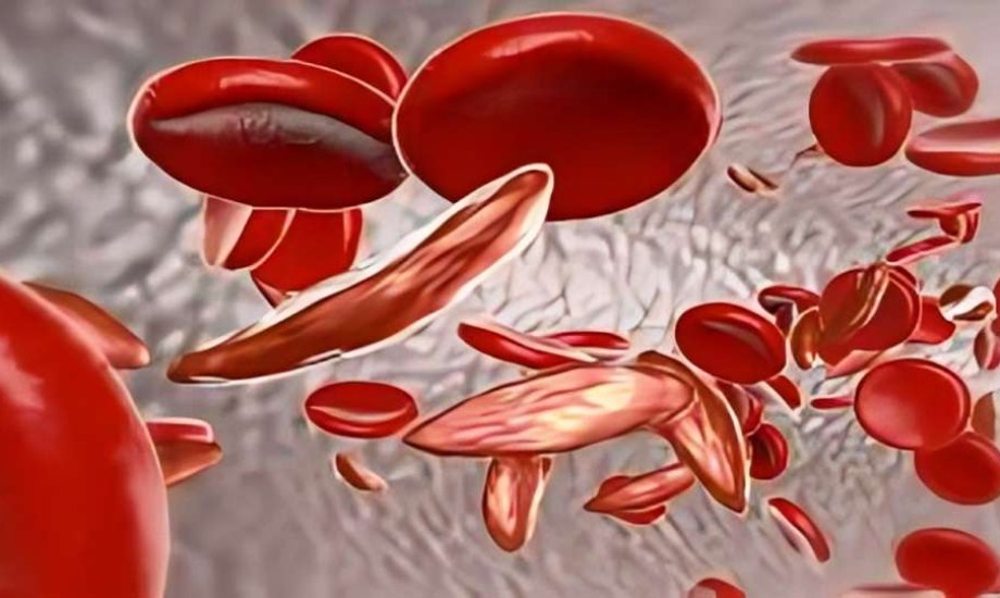 تحديثات دوائية مهمة.. تطورات جديدة في علاج الأنيميا المنجلية