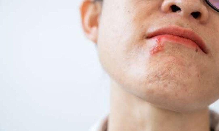 أدوات التدخين تنقل الهربس