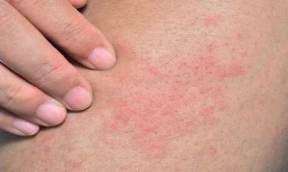 10 علاجات منزلية مذهلة تخلصك من الطفح الحراري في أيام