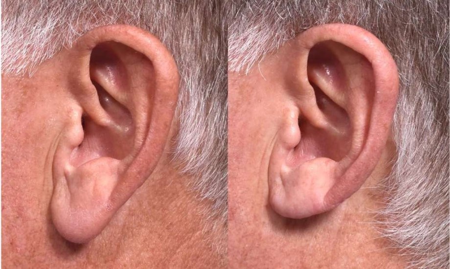 تصغير شحمة الأذن.. موضة تجميلية جديدة تجذب الرجال