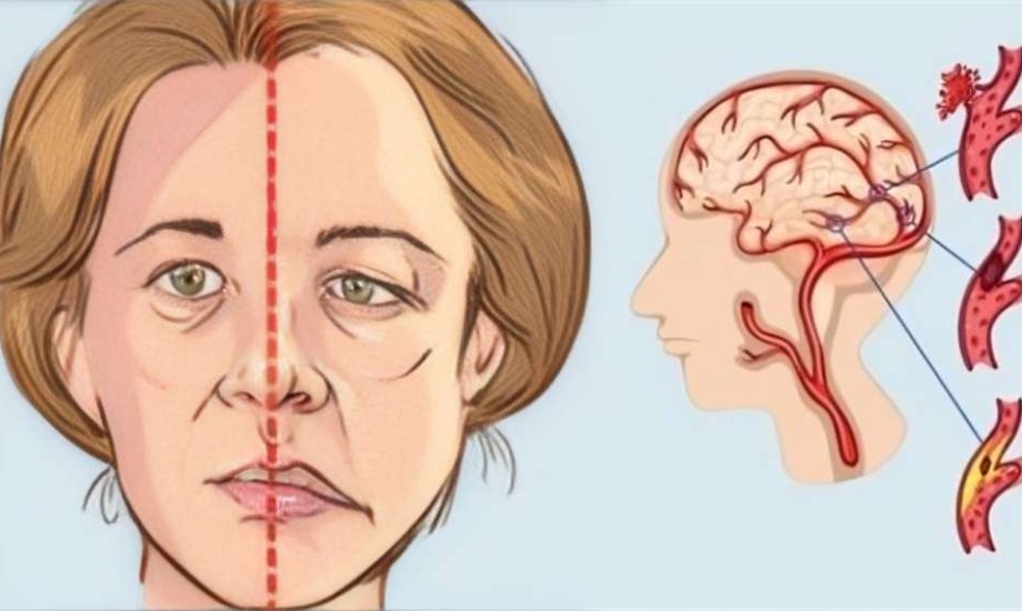 5 مضاعفات للحمل قد تنبئ بالسكتة الدماغية بعد عقود