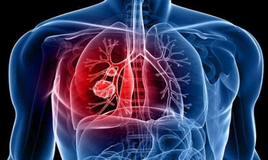 دواء Zegfrovy.. أول علاج فموي يستهدف طفرة أورام الرئة