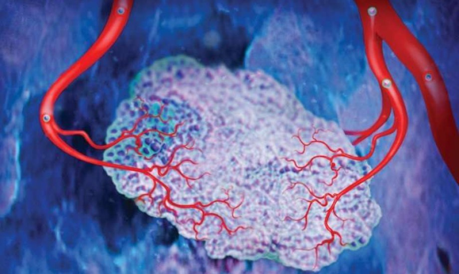 كيف يتحول وعاء دموي صغير إلى قنبلة تهدد حياتك؟